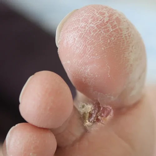 Athelete's Foot Common Foot Problems Copy