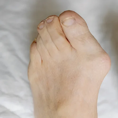 Bunion Common Foot Problems Copy
