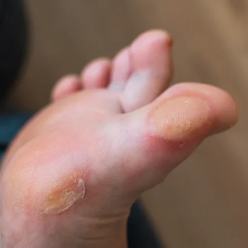 Callus Common Foot Problems