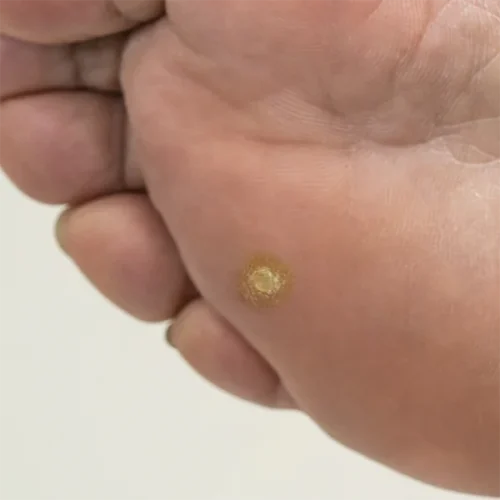 Corn Common Foot Problems