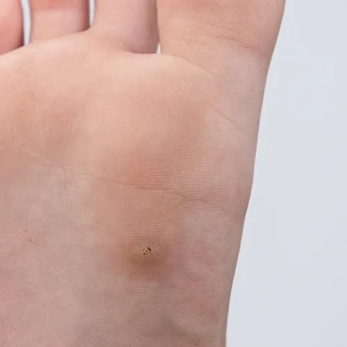 Verruca Common Foot Problems